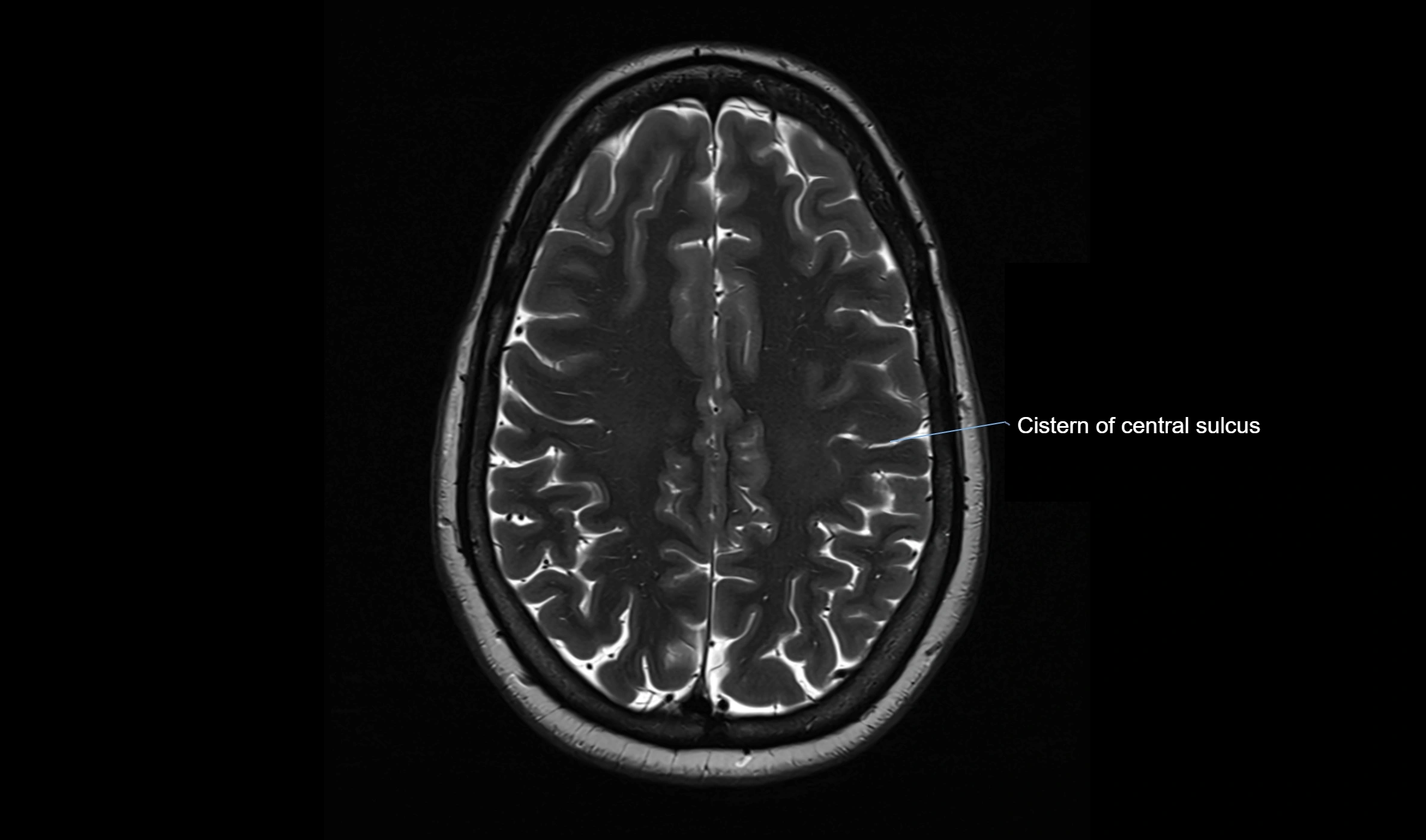 Brain cisterns  and ventricles  axial anatomy 3T MRI image-img-00001-00042.webp